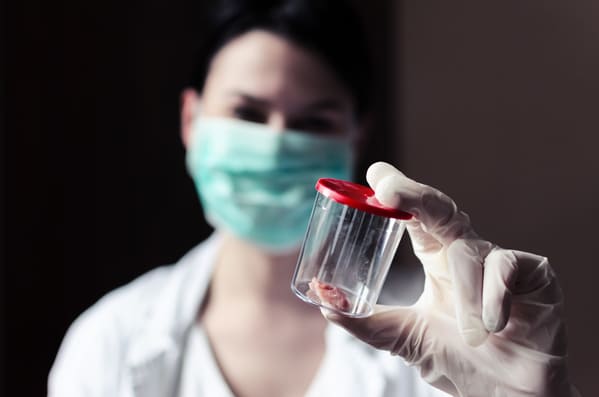 biopsia de mama