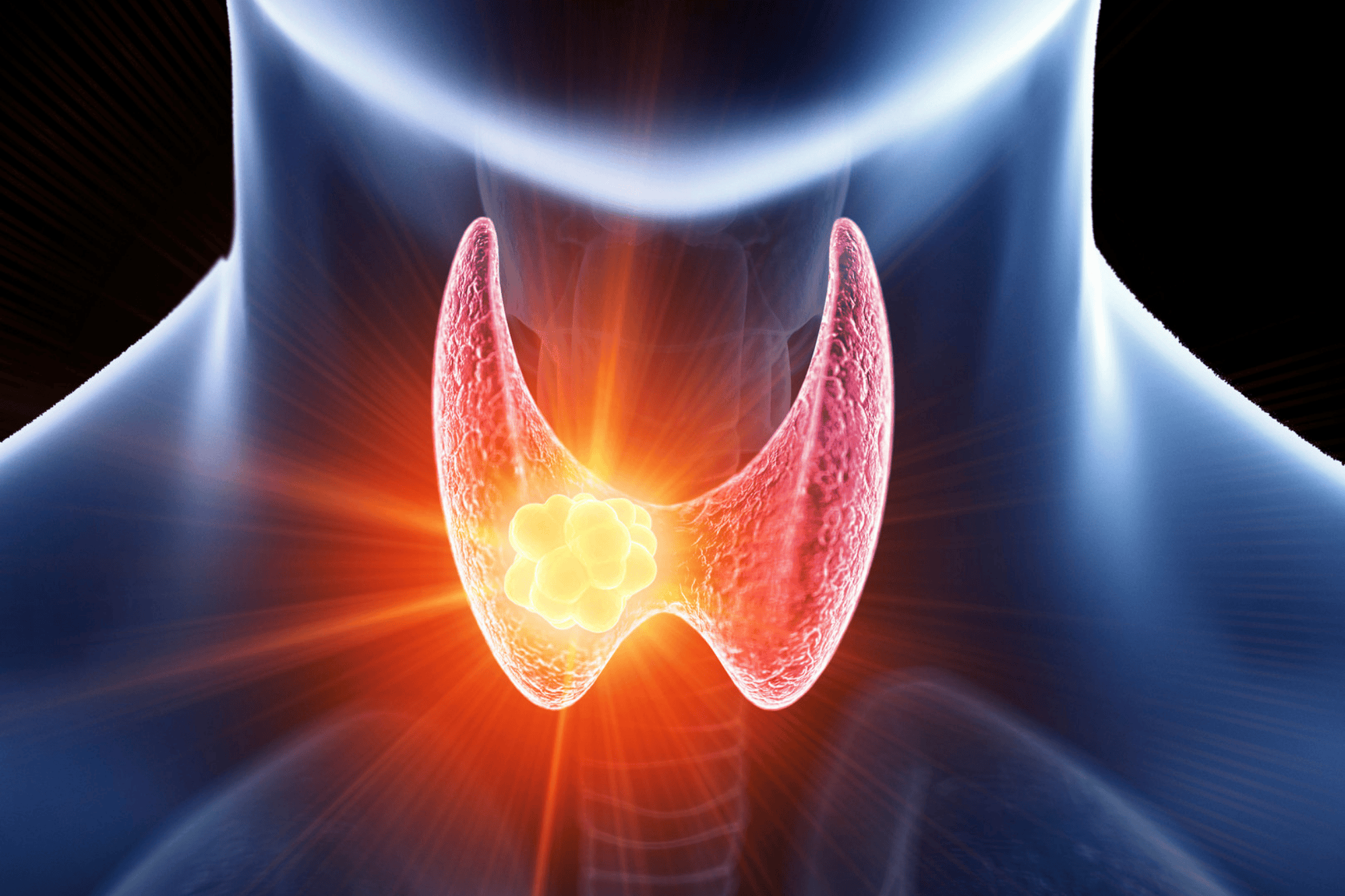Ilustração médica do pescoço humano mostrando a glândula tireoide em destaque, com um nódulo brilhante na região central, representando nódulo na tireoide. A área ao redor aparece iluminada em tons de vermelho e laranja para indicar possível inflamação ou alteração.